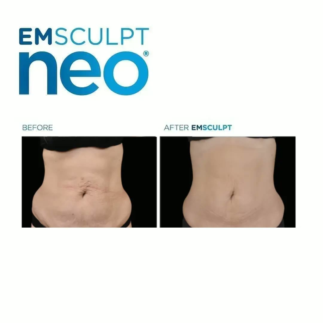 Emsculpt Neo before and after — Abdomen · front view