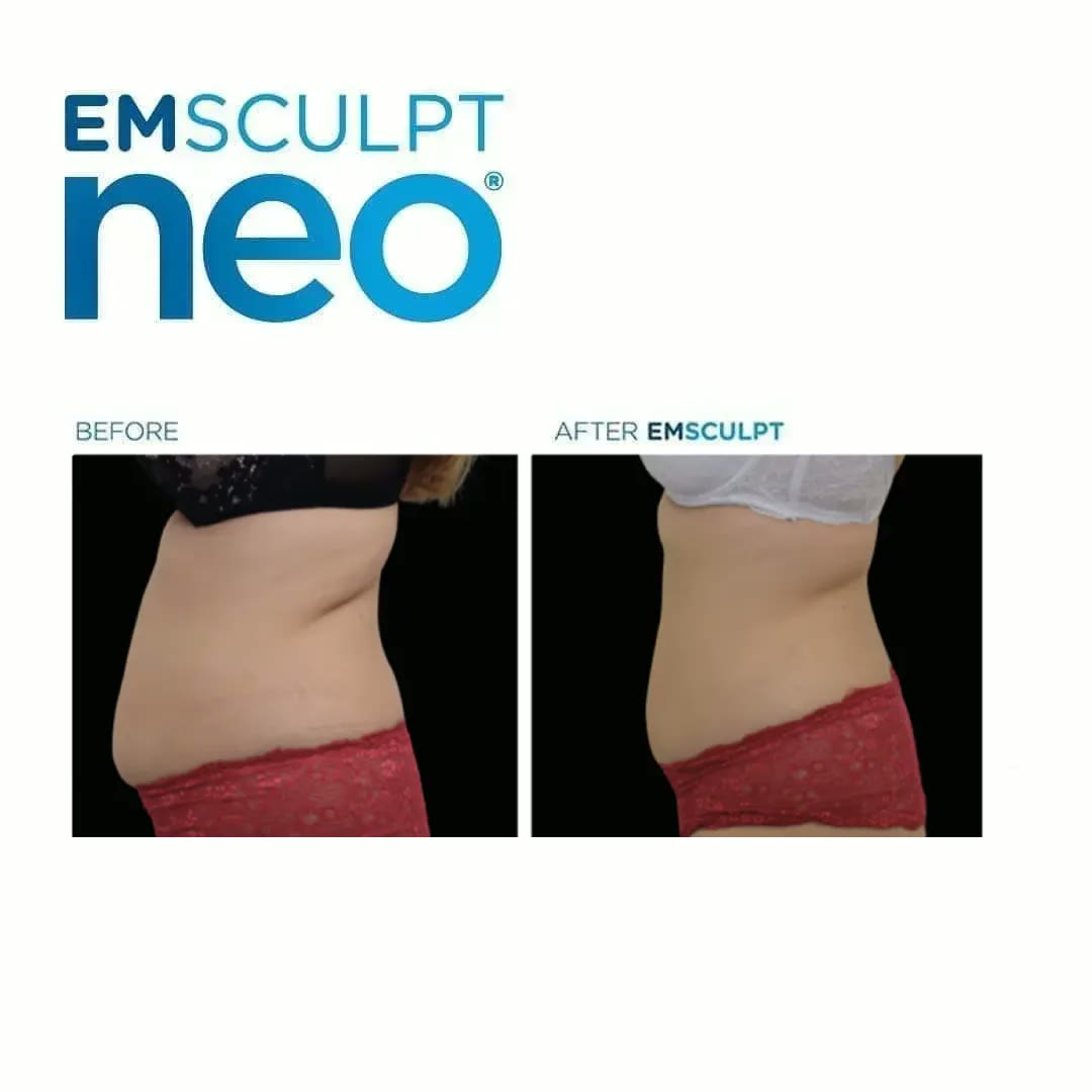 Emsculpt Neo before and after — Abdomen & flanks